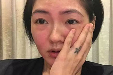 換季皮膚過敏怎么辦？六大致敏誤區(qū)!